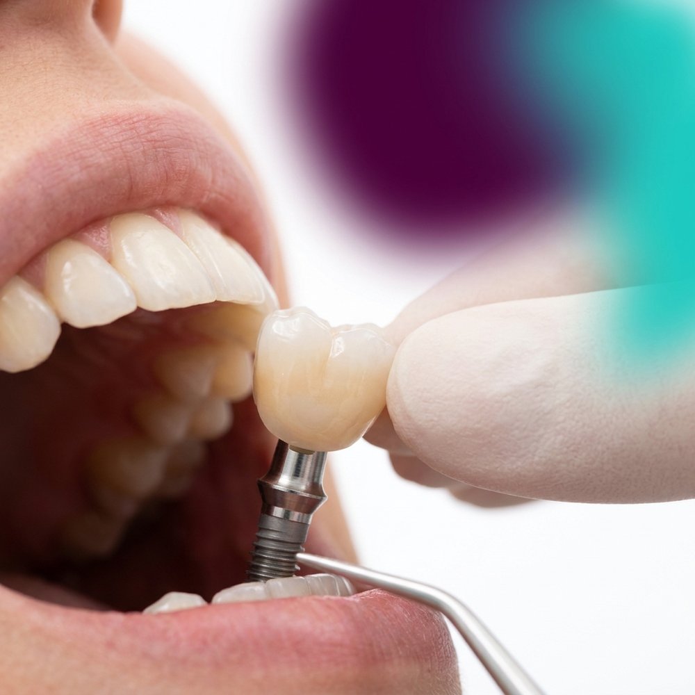 Revisão e manutenção de prótese protocolo sobre implantes